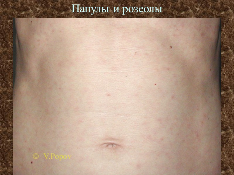 Папулы и розеолы